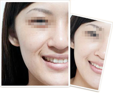 单眼皮、上眼睑松弛