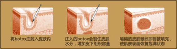 BOTOX肉毒素除皱