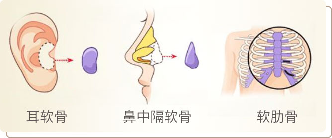 自体软骨隆鼻材料